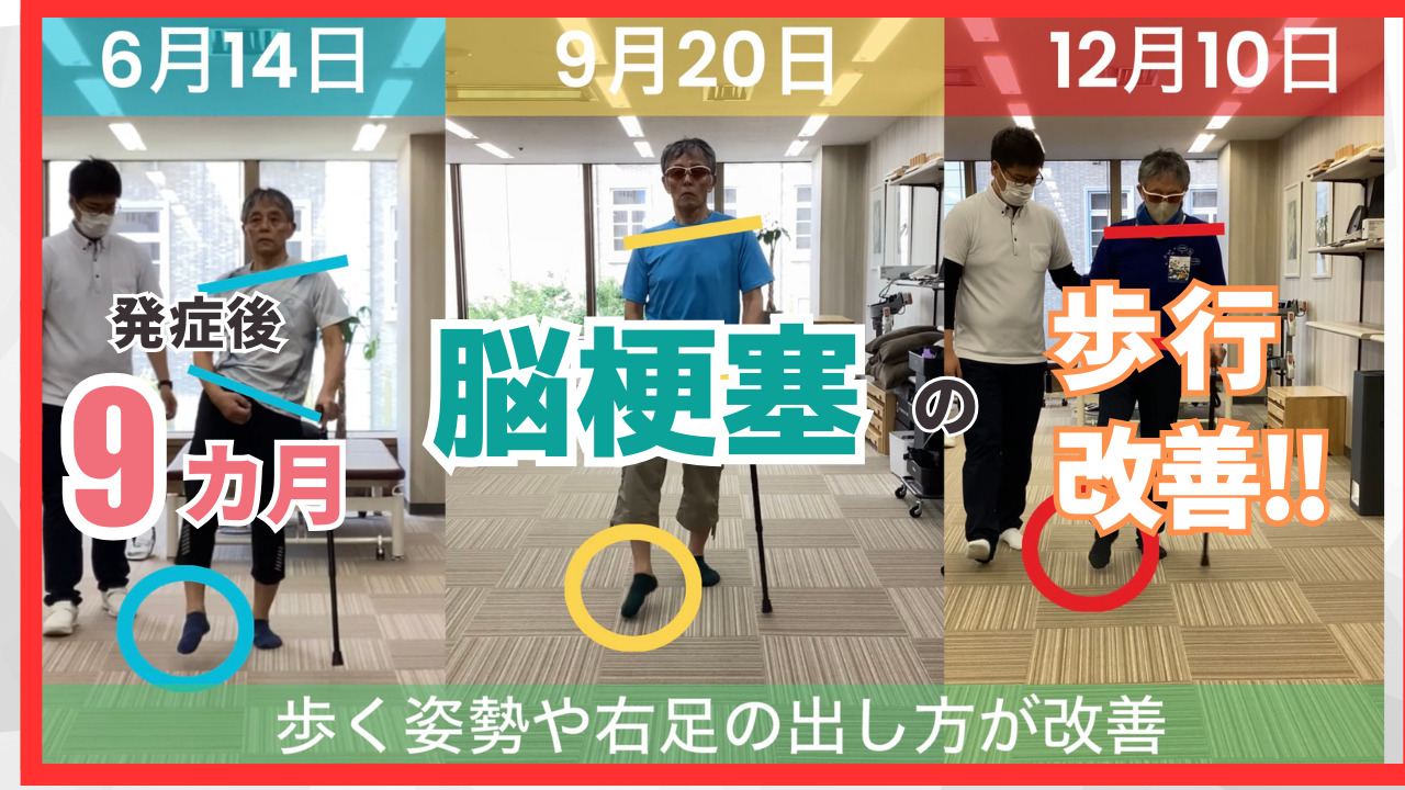 【発症後9カ月】60代男性・武藤様・脳梗塞・歩行の改善事例③　