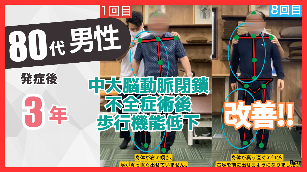 【発症後3年】80代男性　中大脳動脈閉鎖不全症術後の改善事例