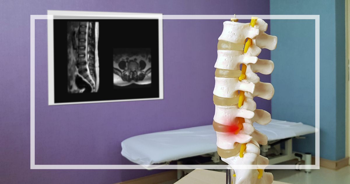 脊柱管狭窄症とは？