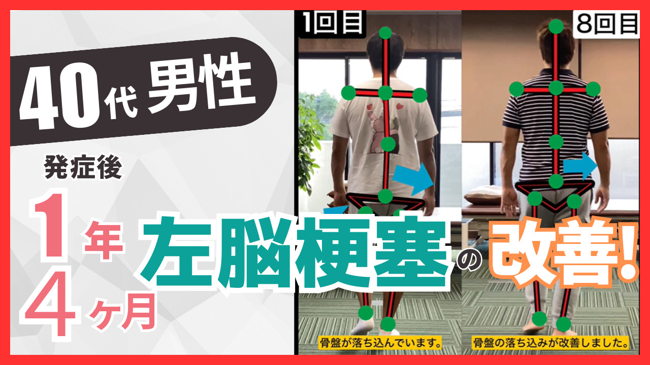 【発症後1年４か月】40代男性・AN様・左脳梗塞の改善事例