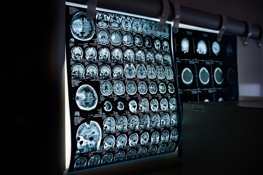 脳画像　MRI